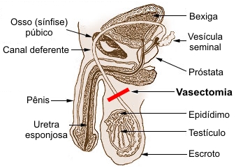 Vasectomia.jpg